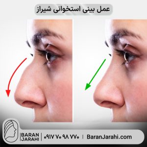 عمل بینی استخوانی شیراز عمل بینی استخوانی شیراز