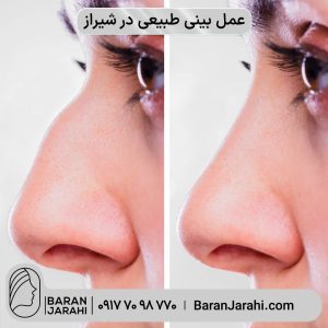 عمل بینی طبیعی در شیراز عمل بینی طبیعی در شیراز