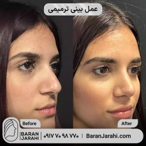 عمل بینی ترمیمی در شیراز عمل بینی ترمیمی در شیراز