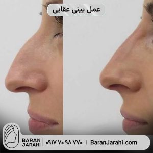 عمل بینی عقابی در شیراز عمل بینی عقابی در شیراز