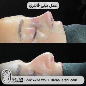 عمل بینی فانتزی در شیراز عمل بینی فانتزی در شیراز